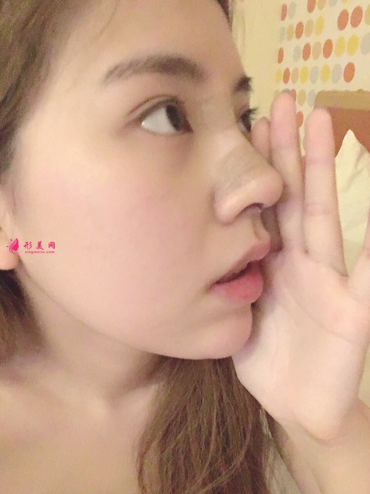 鼻頭鼻翼縮小手術(shù)案例，術(shù)后恢復(fù)全記錄！