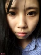 軟骨隆鼻手術(shù)要多少錢？真人案例對(duì)比圖來了！