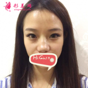 上海九院整形科假體隆鼻半年后效果真心不錯(cuò) 沒有留疤