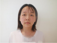 上海九院眼部整形案例分享|30天恢復(fù)效果圖展示