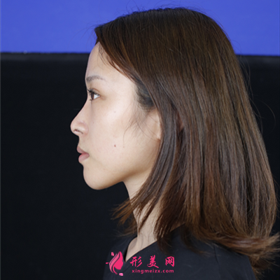 西安鼻綜合手術(shù)術(shù)后恢復(fù)效果分享