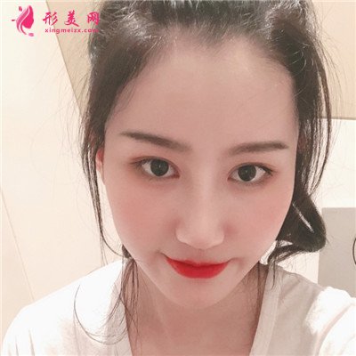 成都自體肋軟骨隆鼻恢復(fù)效果反饋 術(shù)后 成都自體肋軟骨隆鼻恢復(fù)效果反饋