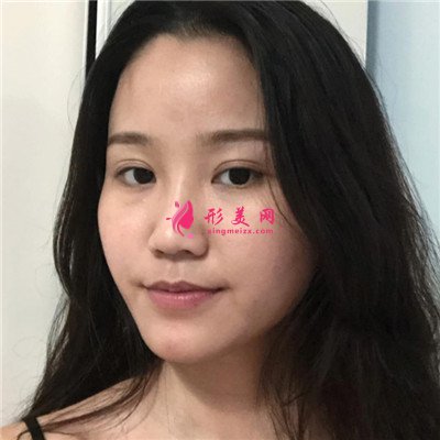 成都自體肋軟骨隆鼻恢復(fù)效果反饋