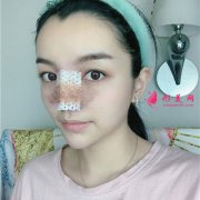 溫州星范整形膨體隆鼻術(shù)后效果分享