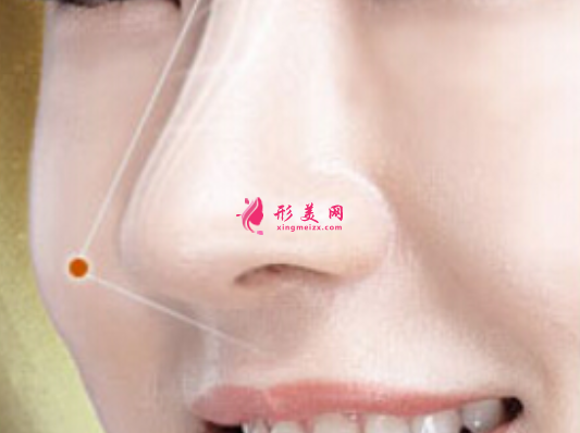 隆鼻手術(shù)注意事項是什么