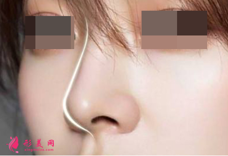 隆鼻手術(shù)注意事項是什么