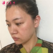 上海伯思立整形面部線雕提升，幫你重回年輕面貌