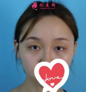 深圳富華醫(yī)療美容醫(yī)院雙眼皮手術恢復圖片 效果怎么樣