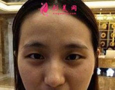 上海時光整形雙眼皮手術(shù)恢復(fù)圖片 術(shù)后效果分享