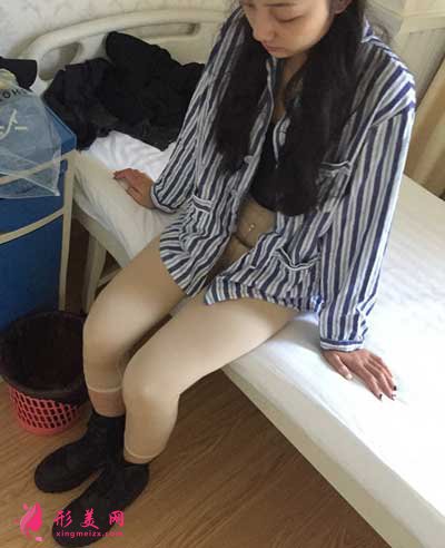 去廣州星團找趙輝做了吸脂瘦大腿手術后第2天