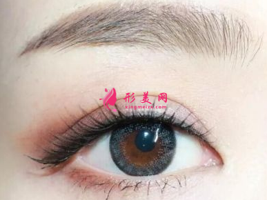 眼睛變大的手術(shù)方法