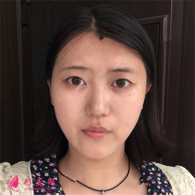 廈門切開雙眼皮手術(shù)恢復(fù)情況對比