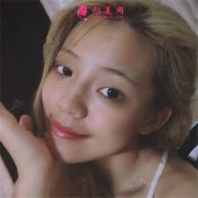成都中醫(yī)大銀海醫(yī)美小姐姐全切雙眼皮術(shù)后恢復(fù)效果分享