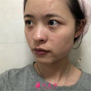 深圳富華醫(yī)療美容醫(yī)院眼綜合術后恢復案例分享