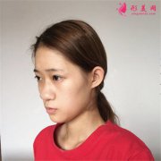 合肥壹加壹整形醫(yī)院膨體隆鼻案例反饋，小姐姐長的很可愛呢~