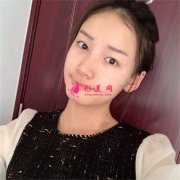  成都劉輔容眼部修復(fù)術(shù)后案例反饋
