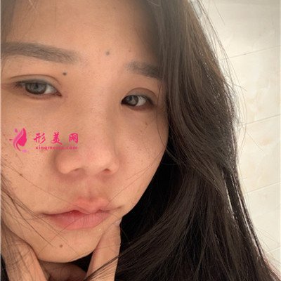 上海硅膠假體隆鼻術后效果反饋