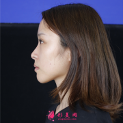 西安西京醫(yī)院鼻綜合手術(shù)術(shù)后恢復效果分享