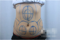 北京純脂整形腰腹吸脂術(shù)后恢復(fù)情況對(duì)比