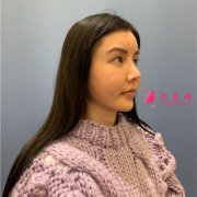 上海九院整形科鼻修復(fù)術(shù)后恢復(fù)案例反饋