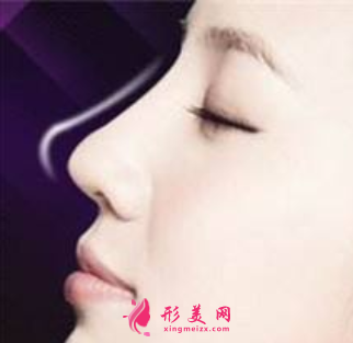 自體肋骨隆鼻保持多久