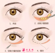 眼袋手術(shù)大概需要多少錢？