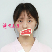 上海九院整形假體隆鼻前后對(duì)比照 術(shù)后顏值爆表