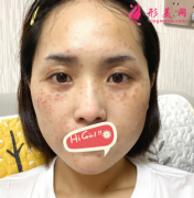 上海九院激光去雀斑后效果圖 無暇美肌上線了