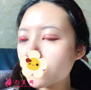 鄭州華領(lǐng)整形醫(yī)院雙眼皮修復(fù)后拯救了我 瞬間變女神