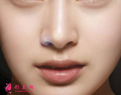 膨體隆鼻歪了怎么辦
