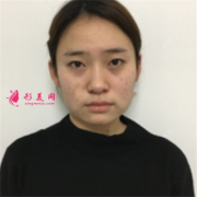 重慶軍科整形醫(yī)院小姐姐吸脂瘦臉術(shù)后案例反饋
