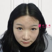 武漢眉毛種植手術(shù)術(shù)后恢復(fù)效果分享
