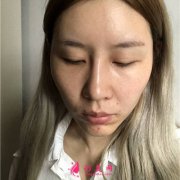 上海伊萊美醫(yī)療美容醫(yī)院鼻綜合術(shù)后恢復(fù)效果對比