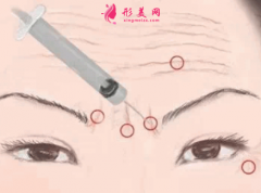 愛(ài)貝芙注射除皺前要注意什么？