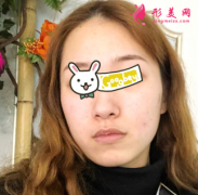廣州華美醫(yī)療美容醫(yī)院熱瑪吉除皺一個月效果很明顯 細紋消失啦