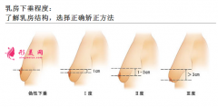 胸部下垂矯正手術(shù)多少錢？