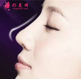 軟骨隆鼻有什么危害