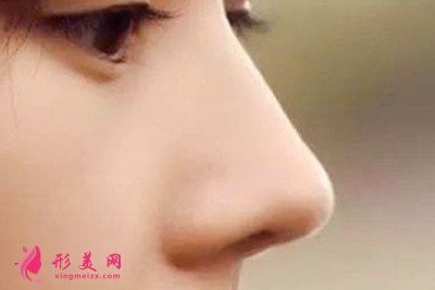 軟骨隆鼻的效果多久穩(wěn)定下來