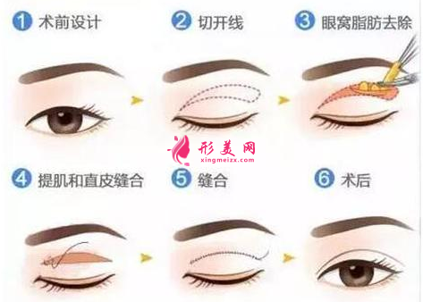 切雙眼皮一般需要多少錢(qián)