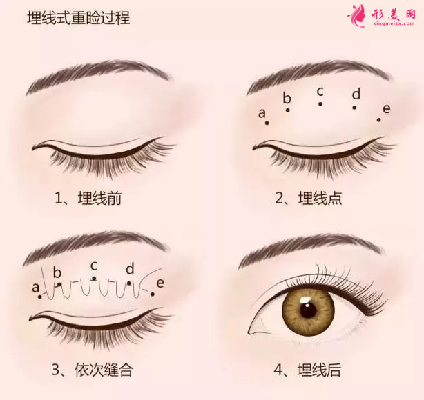 埋線雙眼皮一般多久恢復(fù)正常