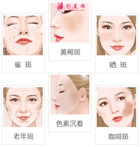 激光祛斑恢復(fù)期如何護(hù)理