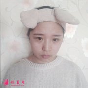 成都軍大整形注射瘦臉針瘦臉術(shù)后效果對比？