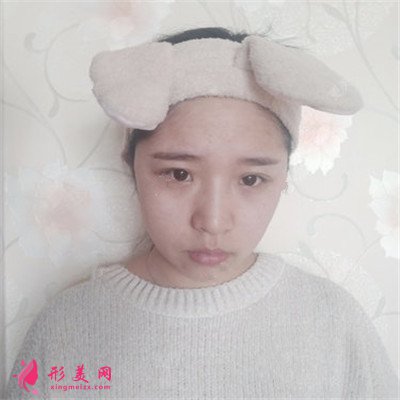 成都注射瘦臉針瘦臉術(shù)后效果對(duì)比