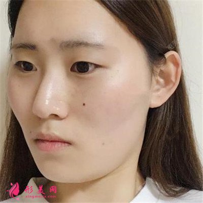 上海小姐姐切開雙眼皮術(shù)后效果分析