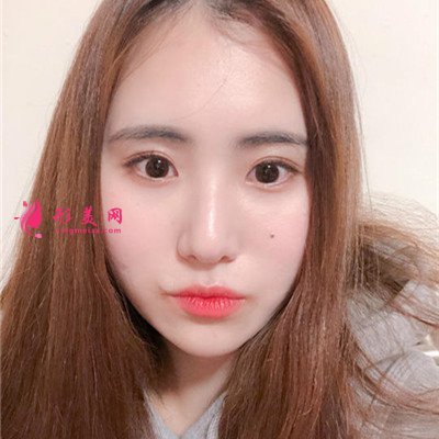 上海小姐姐切開雙眼皮術(shù)后效果分析 術(shù)后 上海小姐姐切開雙眼皮術(shù)后效果分析
