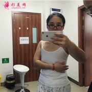 北京京民整形外科漂亮小姐姐假體隆胸術(shù)后恢復情況對比