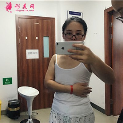 深圳漂亮小姐姐假體隆胸術(shù)后恢復(fù)情況對比