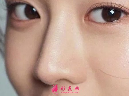 隆鼻歪了怎么修復
