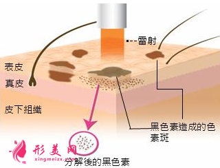 激光祛黃褐斑還會再長嗎
