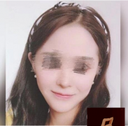 上海九院磨骨案例3個(gè)月圖，我做了精致度滿分的“上鏡臉”！